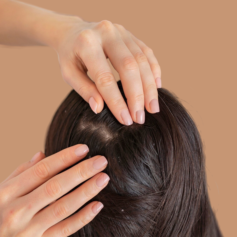 Dandruff