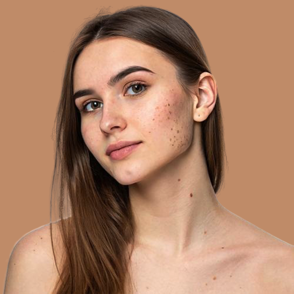 Anti-Hyper Pigmentation & Dark Spots
