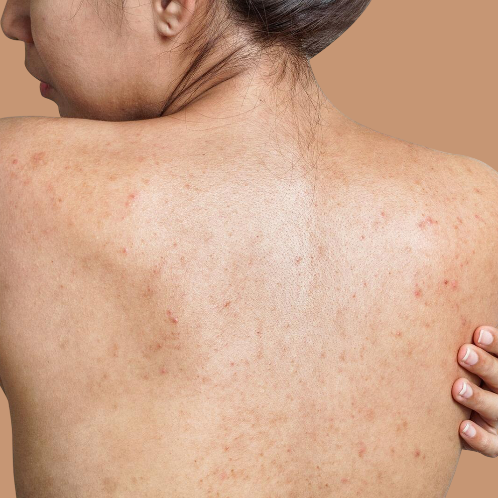 Back Acne